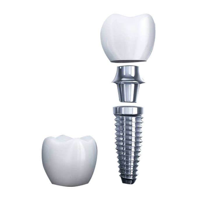 以色列科特斯种植牙