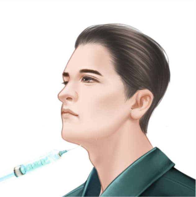 玻尿酸填充下颌缘