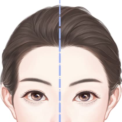 胶原蛋白填充太阳穴