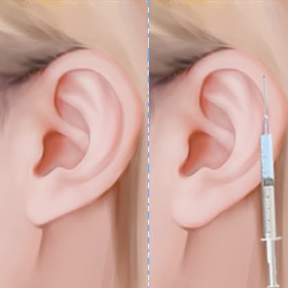 玻尿酸丰耳垂