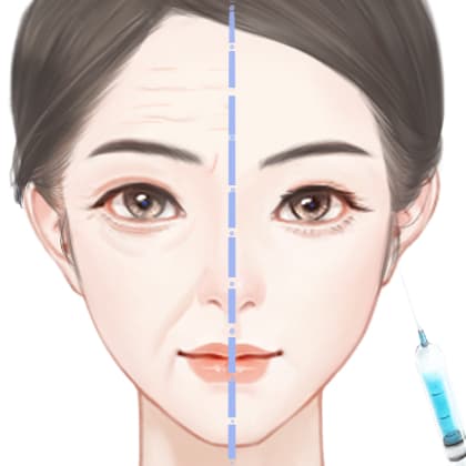 注射去面部细纹