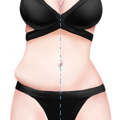 超声溶脂瘦腰部