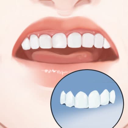 二氧化锆全瓷牙