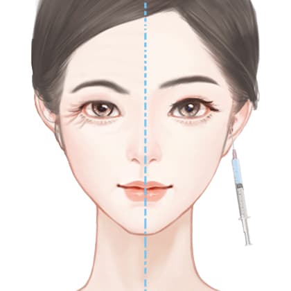 注射去鱼尾纹