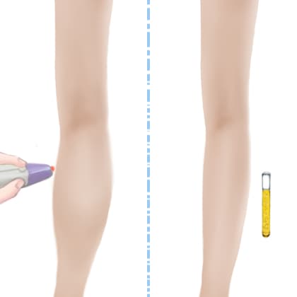 射频溶脂瘦小腿