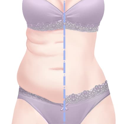 冷冻减脂瘦腹部