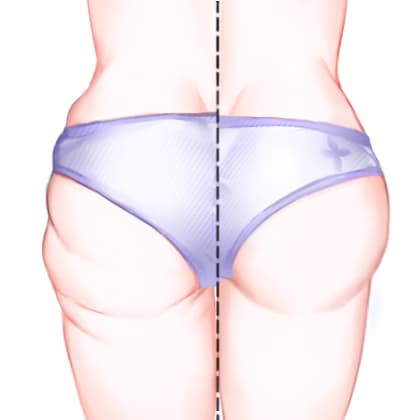 超声溶脂瘦臀部