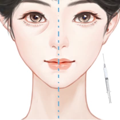 胶原蛋白填充泪沟