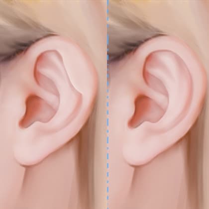 副耳去除术