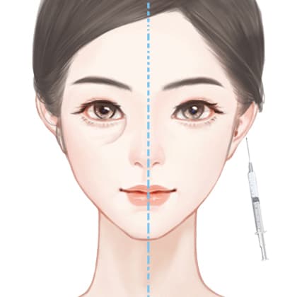 胶原蛋白丰泪沟