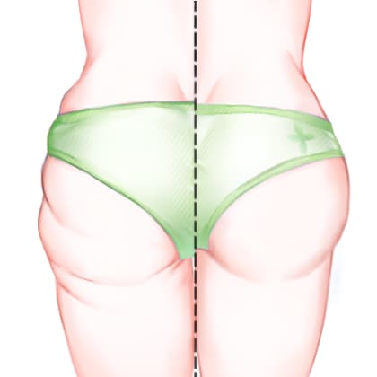 冷冻减脂瘦臀部