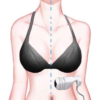 超声溶脂瘦肩部