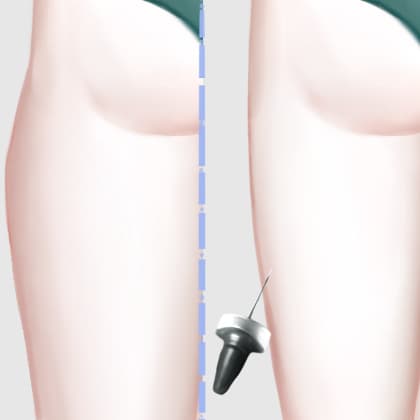 射频溶脂瘦大腿