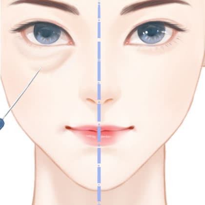 光纤溶脂去眼袋