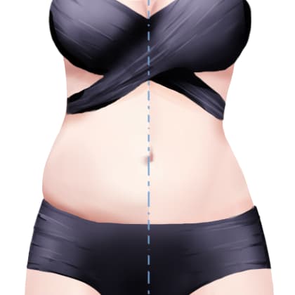 超声溶脂瘦腹部