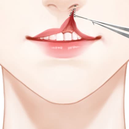唇腭裂手术