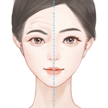 内窥镜手术提升