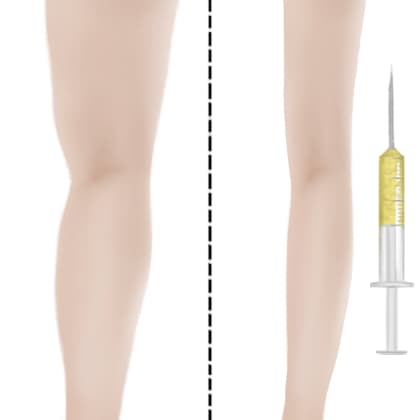 冷冻减脂瘦小腿