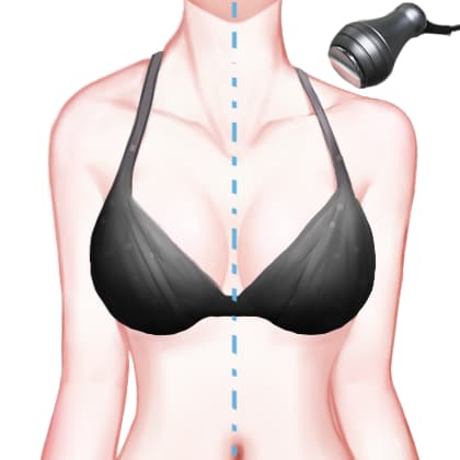 射频溶脂瘦肩膀