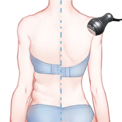 射频溶脂瘦背部