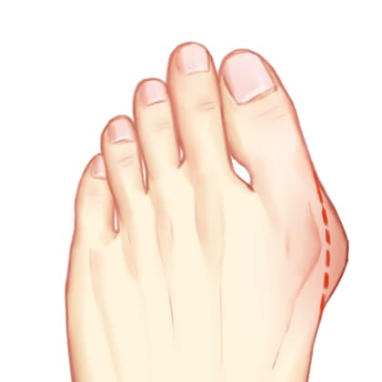 大脚骨矫正