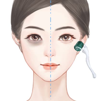 微针淡化黑眼圈