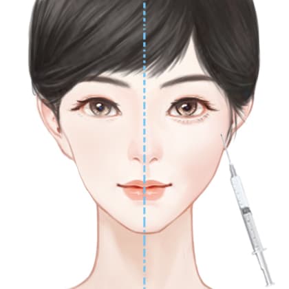 玻尿酸丰苹果肌