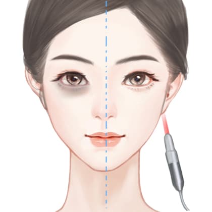 激光淡化黑眼圈