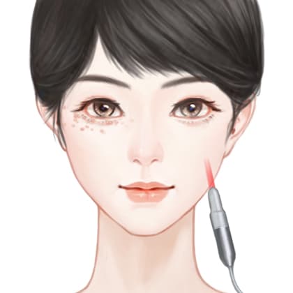 射频淡化黑眼圈