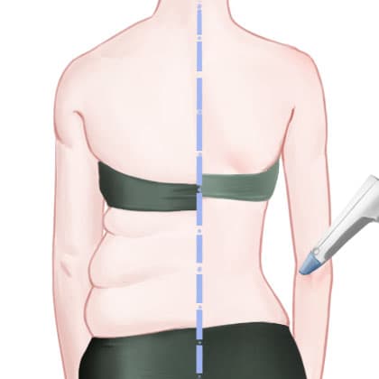 冷冻减脂瘦背部