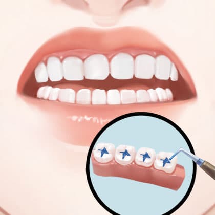 儿童口腔预防窝沟封闭