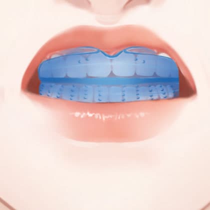 儿童早期干预矫治—mrc肌功能矫治