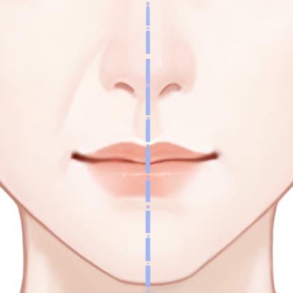 自体脂肪去法令纹