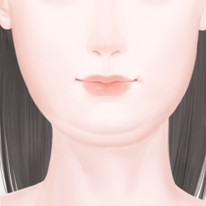 下巴吸脂术/去双下巴