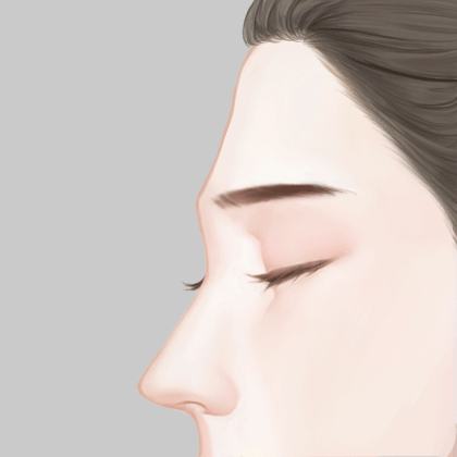 自体脂肪丰额头