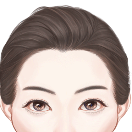 玻尿酸丰太阳穴